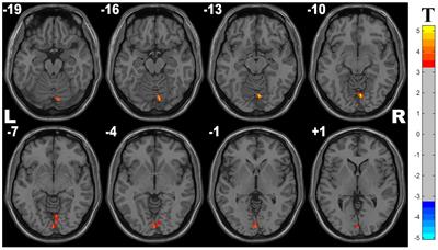 Altered Spontaneous Brain Activity Related to Neurologic and Sleep Dysfunction in Children With Obstructive Sleep Apnea Syndrome